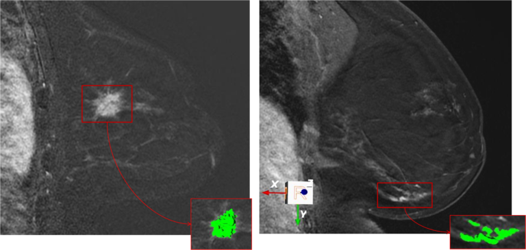 Computer-aided diagnosis for MRI screening of the Breast in high risk ...