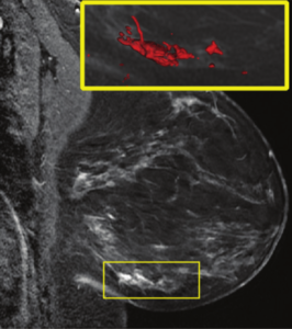 Computer-aided diagnosis for MRI screening of the Breast in high risk women